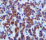 Keratin, LMW Antibody - IHC of Cytokeratin LMW CAM5.2 on FFPE Breast Carcinoma tissue. This image was taken for the unmodified form of this product. Other forms have not been tested.