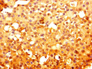 KF1 / RNF103 Antibody - Immunohistochemistry of paraffin-embedded human breast cancer using RNF103 Antibody at dilution of 1:100