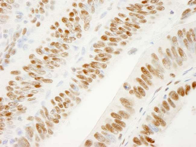 KHDRBS1 / SAM68 Antibody - Detection of Human SAM68 by Immunohistochemistry. Sample: FFPE section of human colon carcinoma. Antibody: Affinity purified rabbit anti-SAM68 used at a dilution of 1:250.