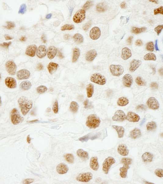 KHDRBS1 / SAM68 Antibody - Detection of Human SAM68 by Immunohistochemistry. Sample: FFPE section of human breast carcinoma. Antibody: Affinity purified rabbit anti-SAM68 used at a dilution of 1:250.
