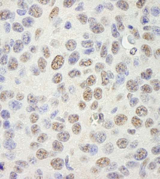 KHDRBS1 / SAM68 Antibody - Detection of Mouse SAM68 by Immunohistochemistry. Sample: FFPE section of mouse CT26 colon carcinoma. Antibody: Affinity purified rabbit anti-SAM68 used at a dilution of 1:100.