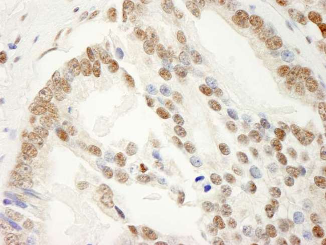 KHDRBS1 / SAM68 Antibody - Detection of Human SAM68 by Immunohistochemistry. Sample: FFPE section of human prostate carcinoma. Antibody: Affinity purified rabbit anti-SAM68 used at a dilution of 1:1000 (0.2 ug/ml). Detection: DAB.