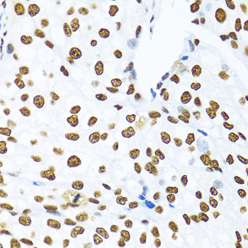 KHDRBS1 / SAM68 Antibody - Immunohistochemistry of paraffin-embedded human prostate cancer tissue.