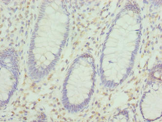 KHDRBS2 / SLM-1 Antibody - Immunohistochemistry of paraffin-embedded human colon cancer using KHDRBS2 Antibody at dilution of 1:100