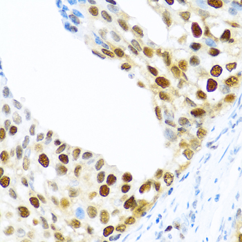 KHDRBS2 / SLM-1 Antibody - Immunohistochemistry of paraffin-embedded human prostate cancer tissue.