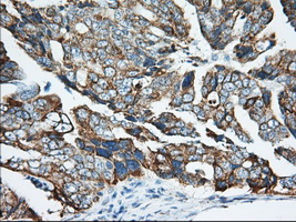 KHK / Ketohexokinase Antibody - IHC of paraffin-embedded Adenocarcinoma of Human ovary tissue using anti-KHK mouse monoclonal antibody. (Dilution 1:50).