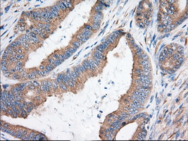 KHK / Ketohexokinase Antibody - IHC of paraffin-embedded Adenocarcinoma of Human colon tissue using anti-KHK mouse monoclonal antibody. (Dilution 1:50).