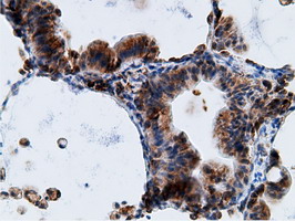 KHK / Ketohexokinase Antibody - IHC of paraffin-embedded Carcinoma of Human lung tissue using anti-KHK mouse monoclonal antibody.