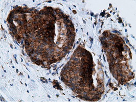 KHK / Ketohexokinase Antibody - IHC of paraffin-embedded Adenocarcinoma of Human breast tissue using anti-KHK mouse monoclonal antibody.