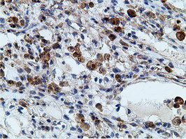 KHK / Ketohexokinase Antibody - IHC of paraffin-embedded Carcinoma of Human kidney tissue using anti-KHK mouse monoclonal antibody.