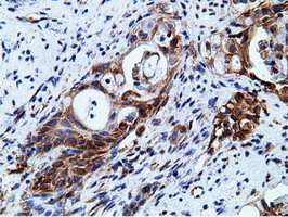 KHK / Ketohexokinase Antibody - IHC of paraffin-embedded Carcinoma of Human pancreas tissue using anti-KHK mouse monoclonal antibody.