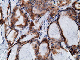 KHK / Ketohexokinase Antibody - IHC of paraffin-embedded Carcinoma of Human thyroid tissue using anti-KHK mouse monoclonal antibody.