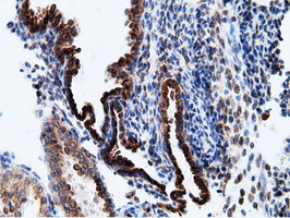 KHK / Ketohexokinase Antibody - IHC of paraffin-embedded Carcinoma of Human prostate tissue using anti-KHK mouse monoclonal antibody.