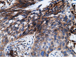 KHK / Ketohexokinase Antibody - IHC of paraffin-embedded Carcinoma of Human bladder tissue using anti-KHK mouse monoclonal antibody.