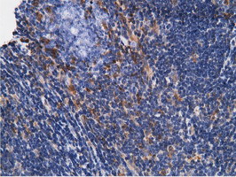 KHK / Ketohexokinase Antibody - IHC of paraffin-embedded Human lymphoma tissue using anti-KHK mouse monoclonal antibody.