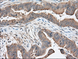 KHK / Ketohexokinase Antibody - IHC of paraffin-embedded Adenocarcinoma of Human colon tissue using anti-KHK mouse monoclonal antibody. (Dilution 1:50).