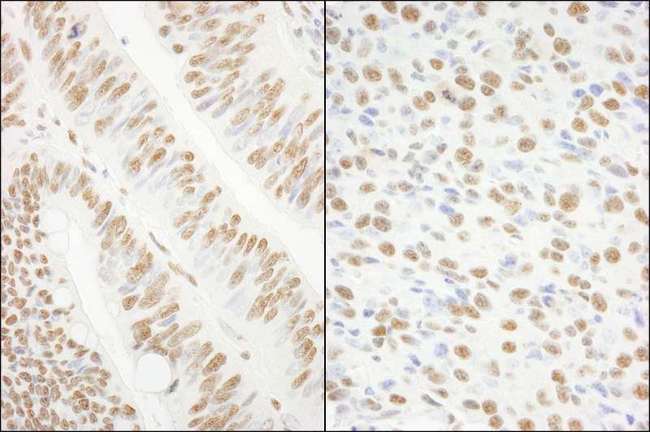 KHSRP / FBP2 Antibody - Detection of Human and Mouse KSRP by Immunohistochemistry. Sample: FFPE section of human colon carcinoma (left) and mouse squamous cell carcinoma (right). Antibody: Affinity purified rabbit anti-KSRP used at a dilution of 1:1000 (0.2 Detection: DAB.