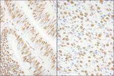 KHSRP / FBP2 Antibody - Detection of Human and Mouse KSRP by Immunohistochemistry. Sample: FFPE section of human colon carcinoma (left) and mouse squamous cell carcinoma (right). Antibody: Affinity purified rabbit anti-KSRP used at a dilution of 1:1000 (0.2 Detection: DAB.