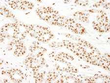 KHSRP / FBP2 Antibody - Detection of Human KSRP by Immunohistochemistry. Sample: FFPE section of human breast carcinoma. Antibody: Affinity purified rabbit anti-KSRP used at a dilution of 1:1000 (1 Detection: DAB.