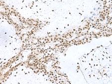 KIAA0020 / PEN Antibody - Immunohistochemistry of paraffin-embedded Human breast cancer tissue  using PUM3 Polyclonal Antibody at dilution of 1:80(×200)