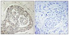 KIAA0100 / BCOX Antibody - Immunohistochemistry analysis of paraffin-embedded human breast carcinoma, using K0100 Antibody. The picture on the right is blocked with the synthesized peptide.