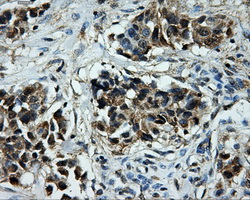 KIAA0153 / TTLL12 Antibody - Immunohistochemical staining of paraffin-embedded Adenocarcinoma of breast tissue using anti-TTLL12 mouse monoclonal antibody. (Dilution 1:50).