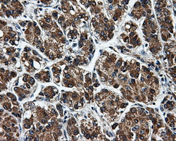 KIAA0153 / TTLL12 Antibody - Immunohistochemical staining of paraffin-embedded Carcinoma of liver tissue using anti-TTLL12 mouse monoclonal antibody. (Dilution 1:50).