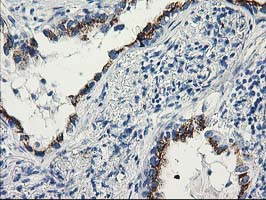 KIAA0153 / TTLL12 Antibody - IHC of paraffin-embedded Carcinoma of Human lung tissue using anti-TTLL12 mouse monoclonal antibody.
