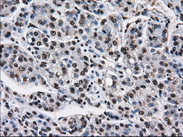 KIAA0153 / TTLL12 Antibody - Immunohistochemical staining of paraffin-embedded Carcinoma of liver tissue using anti-TTLL12 mouse monoclonal antibody. (Dilution 1:50).