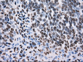 KIAA0153 / TTLL12 Antibody - Immunohistochemical staining of paraffin-embedded Adenocarcinoma of ovary tissue using anti-TTLL12 mouse monoclonal antibody. (Dilution 1:50).