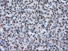 KIAA0153 / TTLL12 Antibody - Immunohistochemical staining of paraffin-embedded Adenocarcinoma of endometrium tissue using anti-TTLL12 mouse monoclonal antibody. (Dilution 1:50).