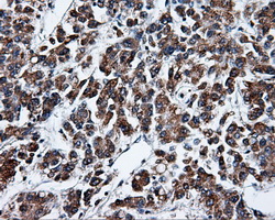 KIAA0153 / TTLL12 Antibody - IHC of paraffin-embedded Carcinoma of liver tissue using anti-TTLL12 mouse monoclonal antibody. (Dilution 1:50).