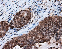 KIAA0153 / TTLL12 Antibody - IHC of paraffin-embedded Adenocarcinoma of ovary tissue using anti-TTLL12 mouse monoclonal antibody. (Dilution 1:50).