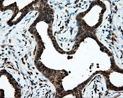 KIAA0153 / TTLL12 Antibody - IHC of paraffin-embedded Carcinoma of prostate tissue using anti-TTLL12 mouse monoclonal antibody. (Dilution 1:50).