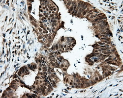 KIAA0153 / TTLL12 Antibody - IHC of paraffin-embedded Adenocarcinoma of colon tissue using anti-TTLL12 mouse monoclonal antibody. (Dilution 1:50).