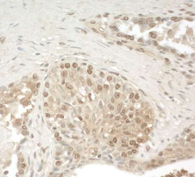 KIAA0191 / ZCCHC11 Antibody - Detection of Human ZCCHC11 by Immunohistochemistry. Sample: FFPE section of human prostate carcinoma. Antibody: Affinity purified rabbit anti-ZCCHC11 used at a dilution of 1:250.