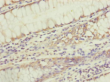 KIAA0391 Antibody - Immunohistochemistry of paraffin-embedded human colon cancer at dilution of 1:100