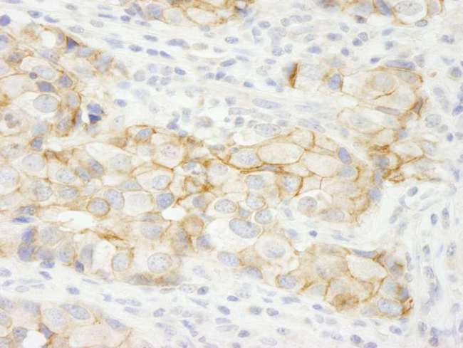 KIAA0528 Antibody - Detection of Human KIAA0528 by Immunohistochemistry. Sample: FFPE section of human breast carcinoma. Antibody: Affinity purified rabbit anti-KIAA0528 used at a dilution of 1:250.