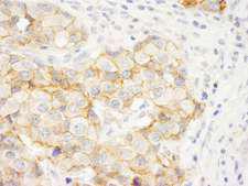KIAA0528 Antibody - Detection of Human KIAA0528 by Immunohistochemistry. Sample: FFPE section of human breast carcinoma. Antibody: Affinity purified rabbit anti-KIAA0528 used at a dilution of 1:1000 (1 Detection: DAB.