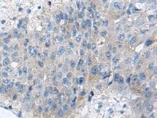 KIAA0556 Antibody - Immunohistochemistry of paraffin-embedded Human liver cancer tissue  using KIAA0556 Polyclonal Antibody at dilution of 1:70(×200)