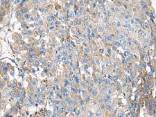 KIAA0556 Antibody - Immunohistochemistry of paraffin-embedded Human liver cancer tissue  using KIAA0556 Polyclonal Antibody at dilution of 1:90(×200)
