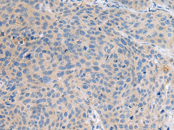 KIAA0556 Antibody - Immunohistochemistry of paraffin-embedded Human cervical cancer tissue  using KIAA0556 Polyclonal Antibody at dilution of 1:90(×200)