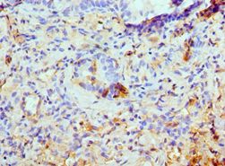 KIAA0652 / ATG13 Antibody - Immunohistochemistry of paraffin-embedded human lung cancer using antibody at 1:100 dilution.