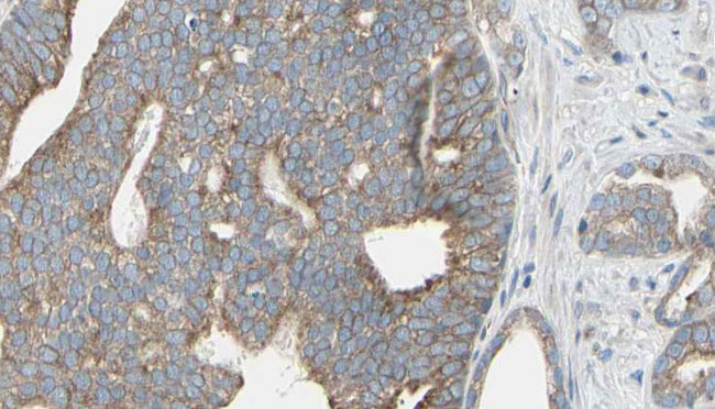 KIAA0652 / ATG13 Antibody - 1:100 staining human prostate tissue by IHC-P. The sample was formaldehyde fixed and a heat mediated antigen retrieval step in citrate buffer was performed. The sample was then blocked and incubated with the antibody for 1.5 hours at 22°C. An HRP conjugated goat anti-rabbit antibody was used as the secondary.
