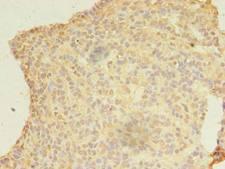 KIAA1257 Antibody - Immunohistochemistry of paraffin-embedded human breast cancer using antibody at dilution of 1:100.