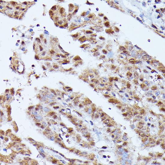 KIAA1429 Antibody - Immunohistochemistry of paraffin-embedded Human thyroid cancer using KIAA1429 Polyclonal Antibody at dilution of 1:100 (40x lens).