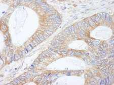 KIAA1524 / p90 Autoantigen Antibody - Detection of Human CIP2A by Immunohistochemistry. Sample: FFPE section of human colon carcinoma. Antibody: Affinity purified rabbit anti-CIP2A used at a dilution of 1:250.