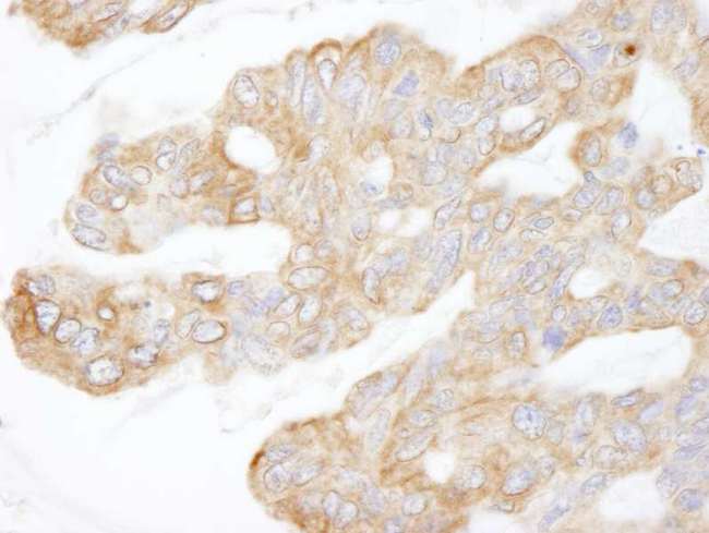 KIAA1524 / p90 Autoantigen Antibody - Detection of Human CIP2A by Immunohistochemistry. Sample: FFPE section of human ovarian carcinoma. Antibody: Affinity purified rabbit anti-CIP2A used at a dilution of 1:250.