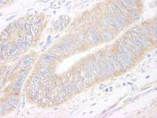 KIAA1524 / p90 Autoantigen Antibody - Detection of Human CIP2A by Immunohistochemistry. Sample: FFPE section of human colon carcinoma. Antibody: Affinity purified rabbit anti-CIP2A used at a dilution of 1:1000 (1 ug/ml).