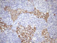 KIAA1524 / p90 Autoantigen Antibody - Immunohistochemical staining of paraffin-embedded Human lymphoma tissue using anti-KIAA1524 mouse monoclonal antibody. (Heat-induced epitope retrieval by 1mM EDTA in 10mM Tris buffer. (pH8.5) at 120 oC for 3 min. (1:150)